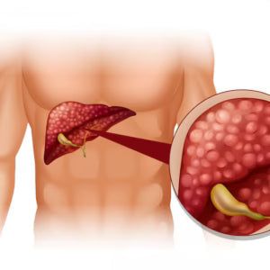 The Fibre and Fatty Liver Disease